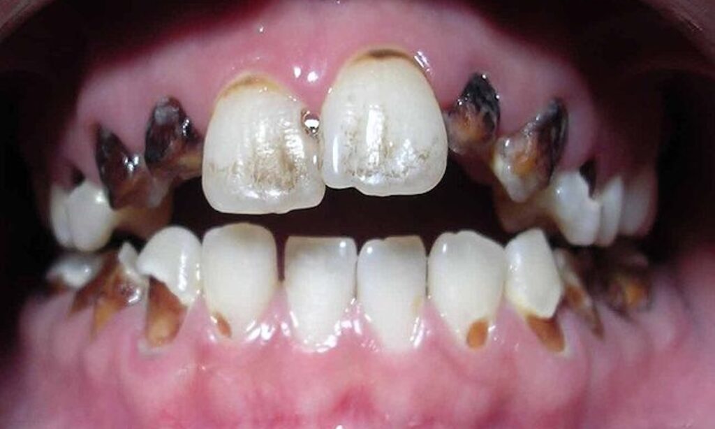 Tooth decay and damage due to meth use or meth mouth.