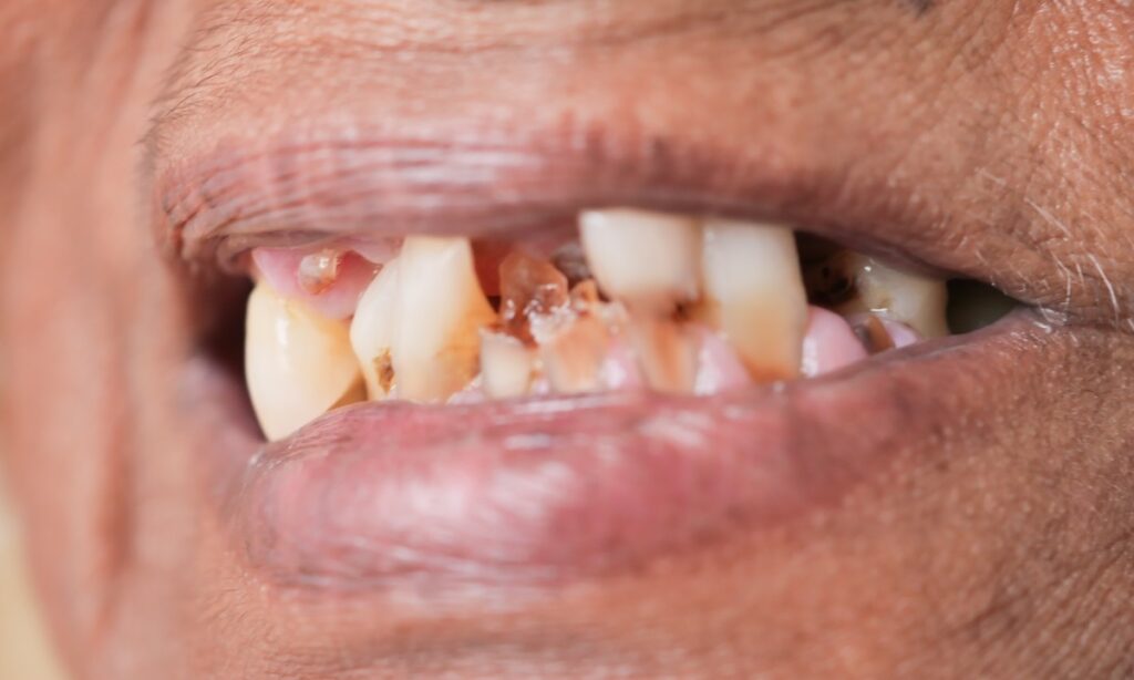 Tooth decay and damage due to meth use or meth mouth.